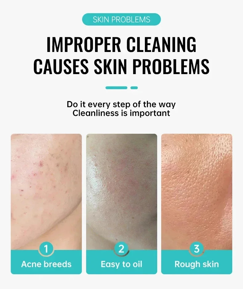 Salicylic Acid Acne Removal Cream - yourelevatedwellness