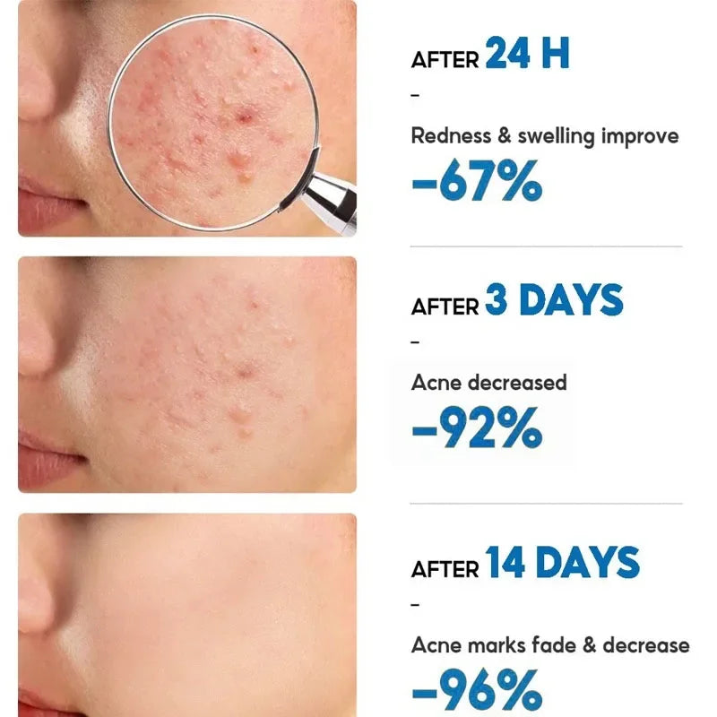 Salicylic Acid Acne Removal Cream - yourelevatedwellness