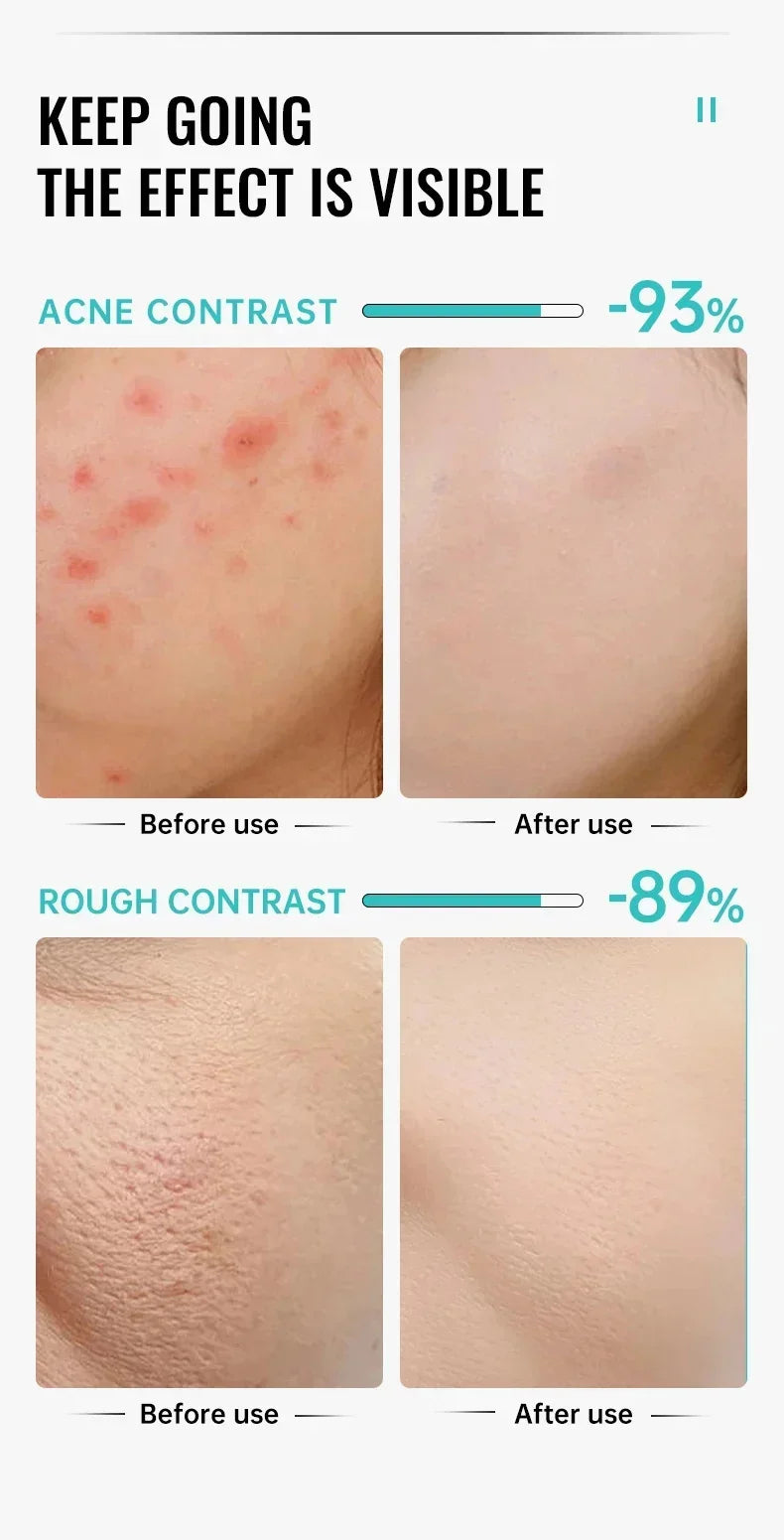 Salicylic Acid Acne Removal Cream - yourelevatedwellness