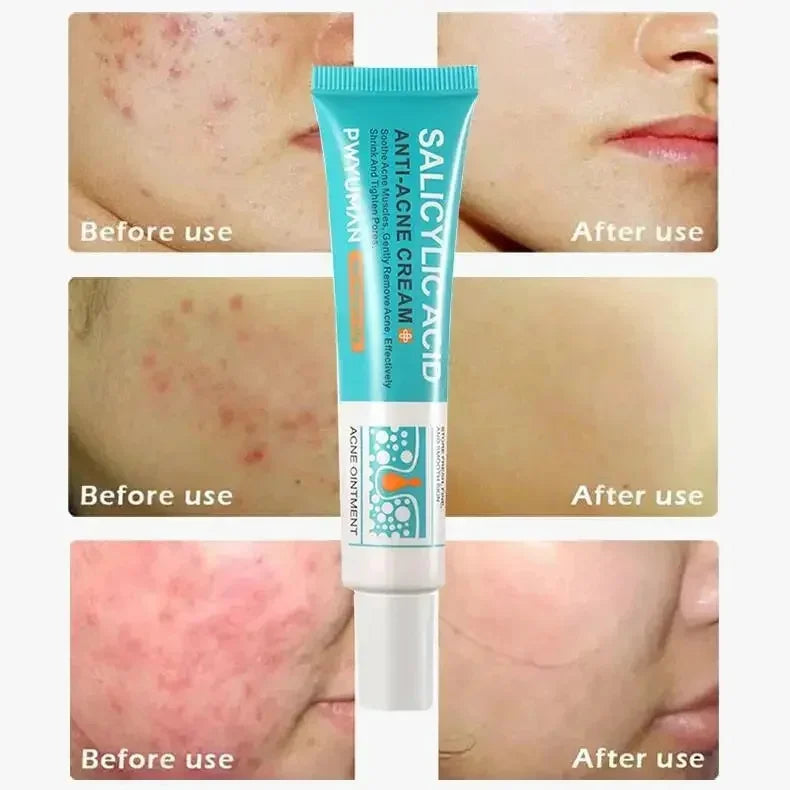 Salicylic Acid Acne Removal Cream - yourelevatedwellness