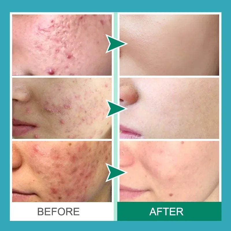 Salicylic Acid Acne Removal Cream - yourelevatedwellness