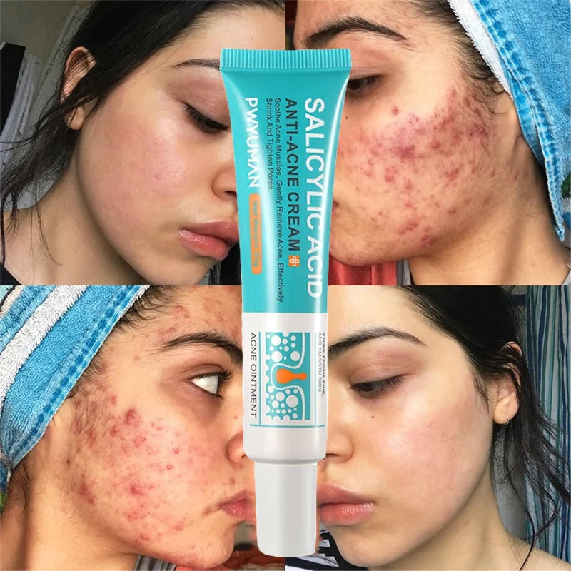 Salicylic Acid Acne Removal Cream - yourelevatedwellness