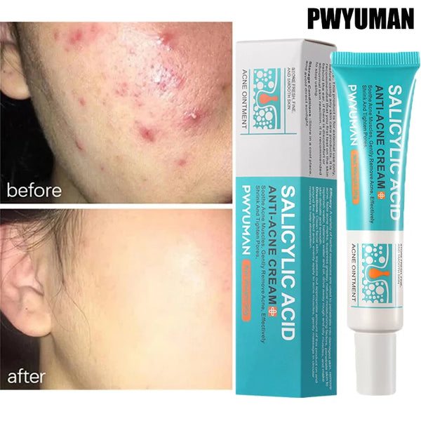 Salicylic Acid Acne Removal Cream - yourelevatedwellness