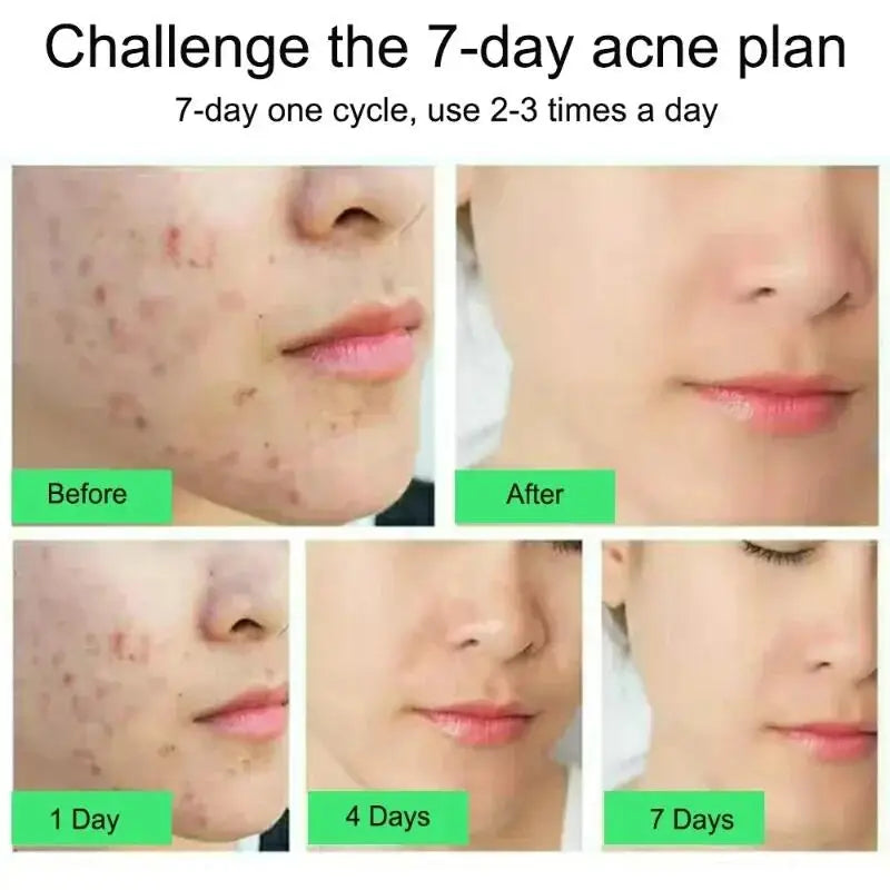 Salicylic Acid Acne Removal Cream - yourelevatedwellness