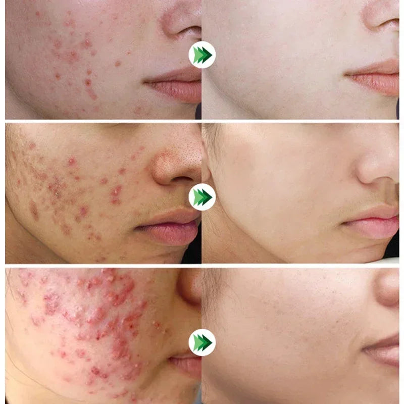 Salicylic Acid Acne Removal Cream - yourelevatedwellness