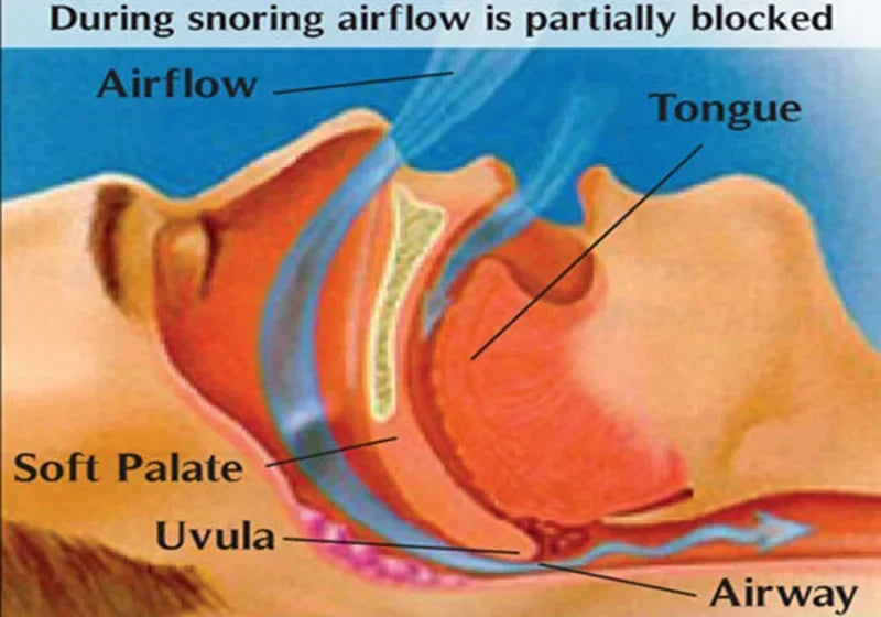 2-Pcs Anti-Snoring Nose Clip – Breathe Easy Sleep Aid - yourelevatedwellness