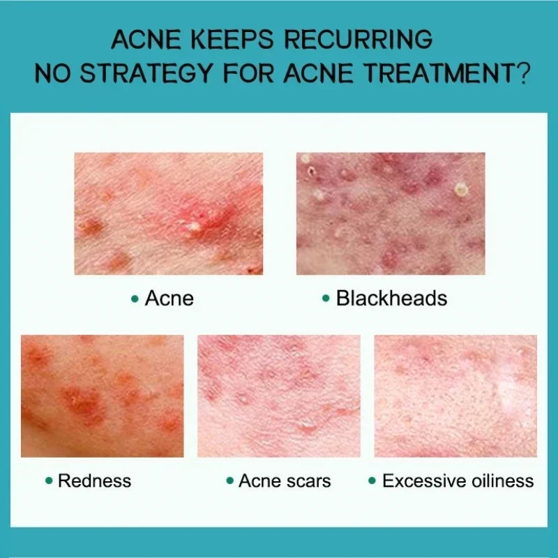 Salicylic Acid Acne Removal Cream - yourelevatedwellness