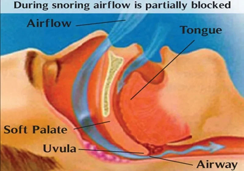 2-Pcs Anti-Snoring Nose Clip – Breathe Easy Sleep Aid - yourelevatedwellness