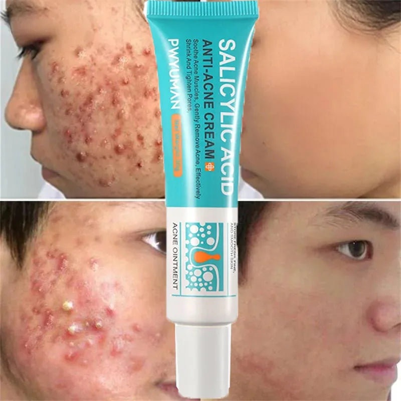 Salicylic Acid Acne Removal Cream - yourelevatedwellness